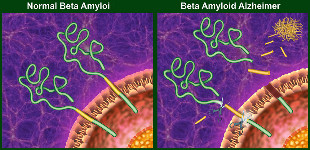 Beta-Amyloid Protein - Barton House Memory Care, Sugar Land, TX
